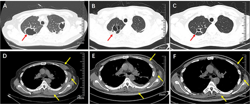 Figure 3 Chest CT on pulmonary lesions and thoracic wall abscess before and after treatment. (A and D) Chest CT scan prior to admission. (B and E) Chest CT scan on discharge. (C and F) Chest CT scan at 3-month follow up. The red arrow indicated the change of the pulmonary cavities. The yellow arrow indicated the change of the thoracic wall abscess.