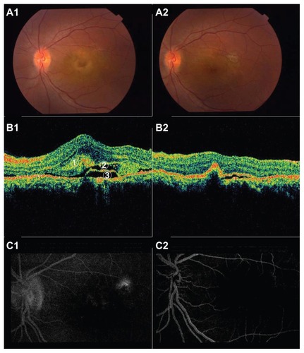 Figure 1 Case 1: Color fundus photography shows serous detachment and yellowish exudates under the retina in the macular area (A1). OCT shows subretinal fibrin, subretinal fluid, and pigment epithelial detachment before treatment (B1). Fluorescein leaking point is temporal to the macular lesion (C1). Post-treatment color photograph shows no serous detachment (A2). OCT shows no retinal detachment but minimal RPE detachment and extrafoveal scar formation at the irradiation area (B2). Fluorescein leakage had subsided (C2).