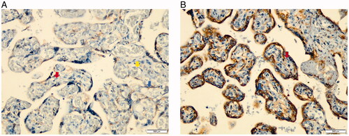 Figure 1. (A) sFlt-1 expression at 400x magnification in Placenta Previa. Percentage of cells 0-10% with weak intensity. Blue arrow indicates IHC stained in the villous trophoblast. Red arrow indicates the mesenchymal cell. Yellow arrow indicates the blood vessel in the placental villous. (B) Strong intensity of sFlt-1 expression of villous trophoblast (blue arrow) at 400x magnification in FIGO grade 3. Red arrow indicates the mesenchymal cell.