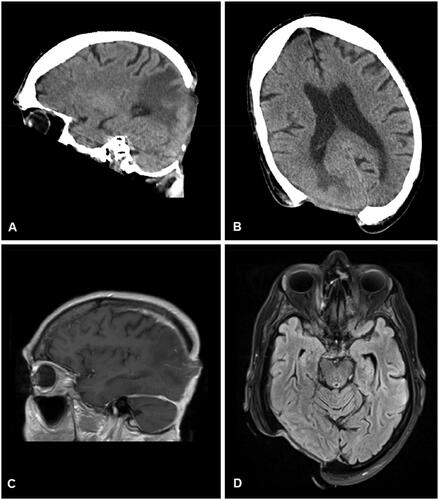 Figure 2. Computed tomographic (A and B) and magnetic resonance imaging (C and D) visualization of the skull defect.