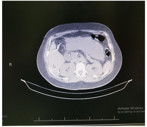 Figure 4 A collection of fluid at the lesser sac.