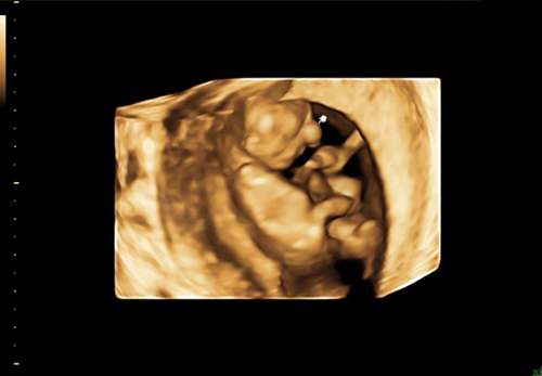 Figure 4 Three-dimensional ultrasound: a circular protrusion (indicated by a white arrow) in the middle of the fetus’ forehead.