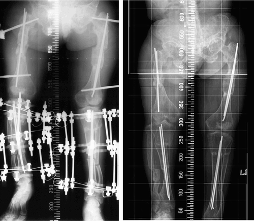 Figure 3. Acute deformity correction after triple-level osteotomies of the femur and double-level osteotomies of the tibia with an external fixator and intramedullary nail (left). After removal of external fixator, showing normal alignment of the mechanical axis of the leg (right).