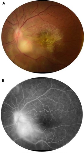 Figure 3 (A) Fundus photograph of the left eye of a patient with ocular tuberculosis shows a juxtapapillary choroidal granuloma with associated papillitis. Note the exudative retinal detachment surrounding the choroidal granuloma and the macular exudates. (B) Late-phase fluorescein angiogram shows leakage of the optic disc and granuloma.
