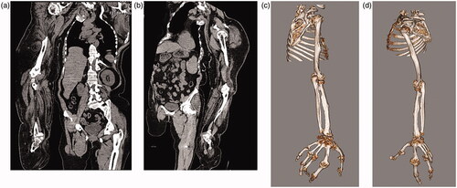 Figures 4. (a–d) CT scans: Adipose tissue hyperplasia was salient in the subcutis and intermuscular stroma of both upper extremities, with bilateral macromelia and macrodactyly. The ring and little fingers of the left hand were not enlarged. Muscles and adipose tissue of the thigh were not atrophied or enlarged. The bilateral overgrowth of muscles of the shoulders, the arms, and the proximal forearms was salient. Adipose infiltration was noted in the stroma of the deltoid muscle and brachial biceps. Muscles of the right forearm were atrophied, and atrophy and adipose degeneration were salient in all muscles of the right hand.