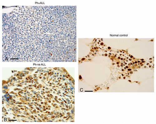 Figure 3 Bone marrow expression of FoxO3 (IHC) (x1,000) in representative patient samples with with Ph+ALL, Ph−ALL and ‘normal’ controls. (A) Bone marrow trephine core biopsies of patients with Ph+ALL show marked downregulation of FoxO3 in all blasts (x1,000). Note the near-complete absence of maturation and absence of cytoplasmic and nuclear FoxO3. Rare myeloid elements show positive staining with FoxO3 (internal control). (B) A patient with Ph-negative ALL. The specimen is cellular with immature blasts. Most blasts are positive for FoxO3 expression in cytoplasm/nuclear localization. (C) Normal controls. The cellularity is sparser than leukemic marrows and shows hematopoietic cells in the insterstitium of normal marrow space and adipose tissue. The hematopoietic cells, specifically myeloid cells, show strong expression of FoxO3.