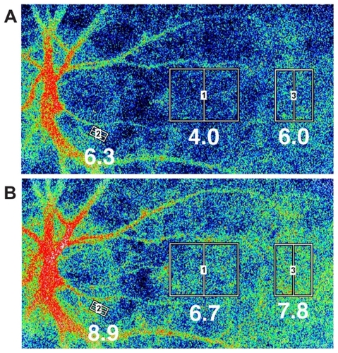 Figure 1 Representative images of the chorioretinal blood flow taken by a LSFG instrument with a SBR. A) Before TES. Squares were positioned in three different areas: the rim of the optic disc flanked by two branched vessels crossing the margin of optic disc. This area was selected so that there were no blood vessels. The other two areas were a point midway between the optic disc and macula and the macula area. The macula area was identified by the region without retinal vessels. B) Twenty-four hours after TES. The averaged SBR values within the square for each measurement are indicated below the square. The color map of chorioretinal blood flow shows an increase of blood flow after TES. In all areas, the chorioretinal blood flow was increased, especially in the midway point.