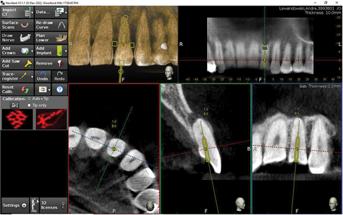 Figure 5. Real time orientation of bur drill path with a dynamic navigation system. Picture courtesy of Dr. Sameer Jain.