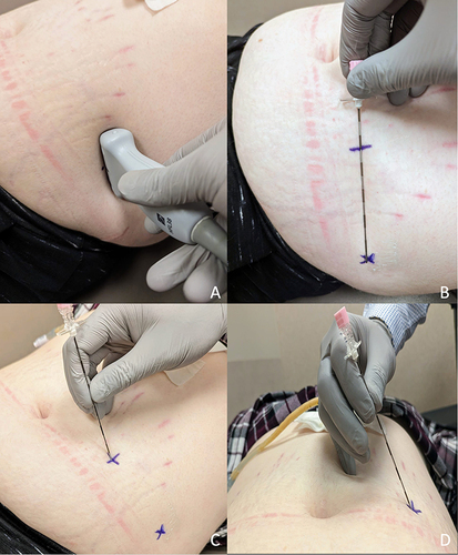 Figure 2 Simulated patient positioning and scanning with ultrasound probe to evaluate underlying anatomy (A). Simulated patient marking to determine starting access point and final proposed lead trajectory (B). The needle is then placed from a medial to lateral fashion from the demarked starting point (C) with proposed angling to parallel the fascial plane once reached (D).