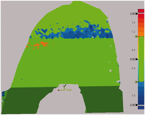 Figure 6. Steps for computing distance errors for the femoral cuts from the nominal cut planes. All five cut surfaces were shape matched to the nominal cut planes. A 3D deviation map was then computed to determine which percentage of the cut surface was within the tolerance of ±1 mm. Green colors indicate that the surface was within tolerance, while red and blue colors indicate that the actual cut was too far outside and inside the planned cut, respectively.