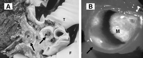 Figure 1. Mucus obstruction of the airways in asthma and COPD: gross pathology. A: Lung from an asthmatic patient cut through to show gelatinous plugs (P) in the large airways (arrows). Courtesy Dr Catherine Corbishley (thumb, T, and finger, F, holding specimen). B: Luminal mucus (M) partially blocking an extrapulmonary bronchus (arrow) in a long‐term elderly male cigarette smoker with chronic sputum production.