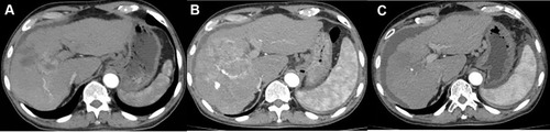 Figure 1 (A) Computed tomography (CT) of the abdomen before intervention showing HCC with a long axis of approximately 75 mm; (B) Disease progression (PD) was observed at the 4-week follow-up after three c-TACE interventions; (C) Complete response (CR) was observed at the 8-week follow-up after DEB-TACE surgery, with reduced lesion volume and no significant active lesion. The patient developed ascites as a sign of advanced hepatic failure.