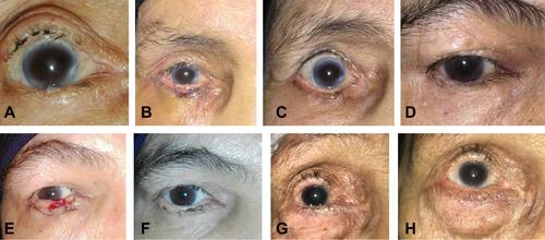 Figure 4 Pre- and postoperative photographs. (A) Preoperative photograph of a patient with a marginal entropion of the central one third of the lower eyelid, and postoperative appearance of the patient at 1 week (B) and 3 months (C) after anterior lamellar recession. (D) Preoperative photograph of another patient with lower eyelid marginal entropion with trichiasis and postoperative appearance at 1 week (E) and 12 months (F) following the same surgical procedure. (G) Preoperative appearance of an elderly woman with lower lid trichiasis without entropion compared to her postoperative appearance at 9 months (H).