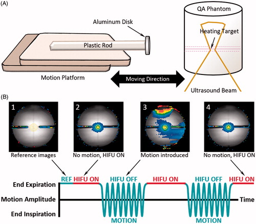 Figure 2. Experimental setup for phantom motion study. An MRI-compatible motion platform was used to create one-dimensional motion to simulate breathing artifacts during hyperthermia treatment. An aluminium disk was taped at the end of a plastic rod to introduce temperature artifacts (A). Reference images (1) for temperature mapping were acquired prior to the treatment with motion being held. HIFU started during first breath hold (2). Artifacts on temperature map were observed (3) when sinusoidal motion was introduced; HIFU was disabled during this period. Treatment resumed when motion was paused with HIFU enabled (4).