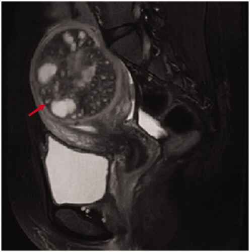 Figure 3. Intramural adenomyosis: the lesion (red arrow heads) was located in the myometrium without any involvement in the junctional zone and the serosa.