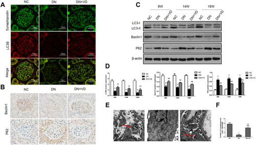 Figure 6 Calcitriol treatment restores autophagy activity in diabetic kidney diseases. SD male rats were intraperitoneally injected with 60 mg/kg streptozotocin. After 3 days, the rats with STZ treatment were garaged with 0.1 μg/kg/d calcitriol or vehicle solution daily for consecutive 18 weeks. Kidney tissues were collected for histology or immunoblot analysis at 18th week. (A) Co-staining of synaptopodin (green) and LC3B (red) proteins in glomeruli by double immunofluorescence staining (400×). (B) Immunohistochemical staining of Beclin-1 and P62 in the renal cortex (400×). (C) Immunoblot analysis of autophagy marker proteins LC3 II/I, Beclin-1 and P62 in renal cortex at 8th, 14th, 18th week in three groups, β-actin was used as a loading control. (D) Quantification of LC3 II/I, Beclin-1 and P62 protein. (E) Representative images showing autophagosomes (black arrow) in podocytes by electron microscopy. (F) Quantification of the autophagosomes (under 10,000/EMP from 8 randomly selected podocytes). Values are mean ± SD (n=6). Significance: *P<0.05 vs NC group, # P<0.05 VS DN group at the same time point group, respectively.