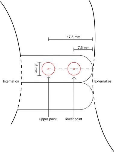 Figure 1 Measurement of ultrasound shear wave speed. Left circle, the region of interest (ROI) of the upper point, right circle, ROI of the lower point. The diameter of the target regions of interest was set to 5 mm.