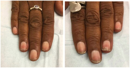 Figure 9. Clinical manifestations of brittle nail syndrome, including lamellar onychoschizia.