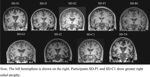 Figure 1. Coronal T1 weighted MRI of the medial temporal lobe for each participant. Note. The left hemisphere is shown on the right. Participants SD-P1 and SD-C1 show greater right sided atrophy.