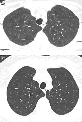 Figure 1.  (a) Axial CT image in a subject with GOLD Stage 1 COPD, where reviewers scored visual emphysema, but quantitative% of emphysema was less than 1%. CT shows mild centrilobular emphysema, which did not reach the quantitative threshold for emphysema. (b) Axial CT image in a subject with GOLD Stage 1 COPD where reviewers scored no visual emphysema, but quantitative% of emphysema was 18%. Close inspection shows multiple small foci of decreased attenuation adjacent to vessels which may either represent dilated peripheral airways or very early emphysema.