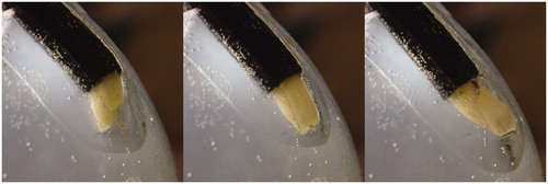 Figure 5. Catheter tip articulation in the in vitro model. From left to right, the catheter at maximum articulation towards the chorioretinal analog, articulation to match the curvature of the model, and maximum articulation towards the scleral analog.