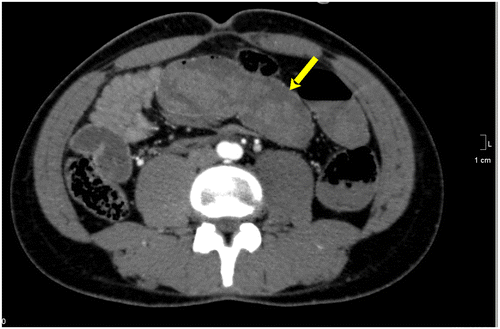 Figure 6a: Axial CT in a known haemophiliac showing SBO secondary to a large hyperdense haematoma (arrow)