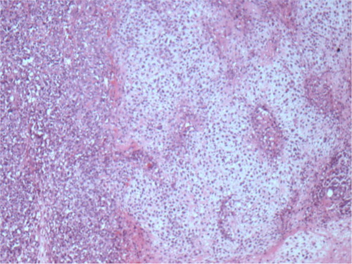 Fig. 1 H&E-stained section at 10× magnification shows a poorly differentiated ductal carcinoma (left side of field) with areas of chondroid (cartilaginous) differentiation (right side of field).