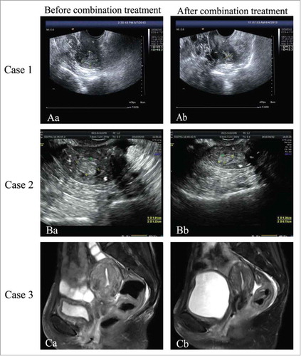 Figure 1. (Aa) 2013-5-7: ultrasound of Case 1 before treatment, tumour was 22·1 × 19·2 × 25·9 mm. (Ab) 2013-6-4: Ultrasound of Case 1 after one month of treatment, tumour was 17·1 × 13·3 × 14·4 mm. (Ba) 2016-5-3: Ultrasound of Case 2 after relapse, tumour was 16 × 14 × 12 mm. (Bb) 2016-8-2: Ultrasound of Case 2 after 2 cycles treatment for relapse, tumour was 13·8 × 13 × 7·5 mm. (Ca) 2016-7-15: Magnetic resonance imaging of Case 3 before combination therapy for relapse. (Cb) 2016-12-23: Magnetic resonance imaging of Case 3 after 6 cycles combination therapy for relapse.