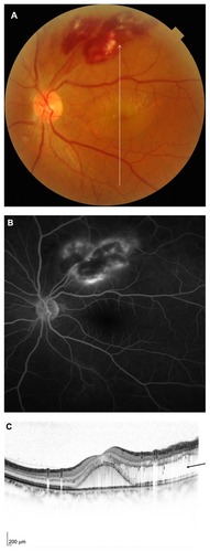 Figure 1 A 49-year-old man (patient 9) with a branch retinal vein occlusion had a 4-week history of blurred vision in his left eye. Best-corrected visual acuity was 0.5. (A) Fundus photograph shows serous macular detachment, hard exudates, and flame-shaped hemorrhages extending from the superior retinal vascular arcade to the superotemporal mid peripheral fundus. The vertical arrow indicates optical coherence tomography scanning lines (8 mm). (B) In the late phase of the fluorescein angiogram, there is marked hyperfluorescence of the superior retinal vascular arcade but no dye leakage in the macular area. (C) A vertical optical coherence tomography scan shows serous retinal detachment at the fovea and outer retinal swelling, which is evident superior to the fovea (arrow).