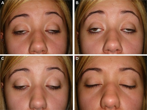 Figure 1 Severe eyelid ptosis and severe reduction of eye movements in a patient with Kearns-Sayre syndrome.