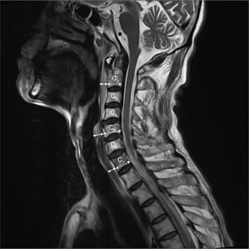 Figure 1 Measurements of RPS in 2nd, 5th and 7th cervical spine level in median sagittal MRI images.