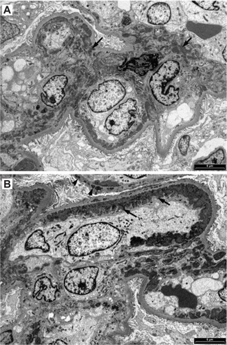 Figure 7 Electron microscopy showing (A) large fine granular deposits in the mesangial region (arrows), (B) prominent fine granular subendothelial deposits (arrows) and some intramembranous deposits (arrow heads) in a case of Class III lupus nephritis.