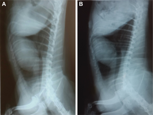 Figure S7 X-ray lateral exposure for Case 3 after treatment.Note: (A) 2 weeks after third treatment, (B) 1 year after third treatment, showing there is no metastasis.