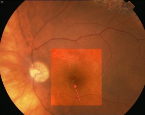 Figure 7 Color fundus enhanced photograph showing the same image observed in the “en-face scan” optical coherence tomography (marked by pink arrow).