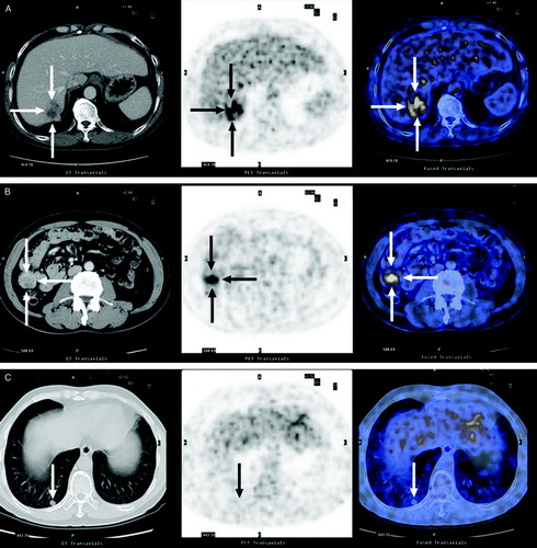 Figure 1.  From left to right, Computed tomography (CT), positron emission tomography using [18F]fluorodeoxyglucose (FDG-PET), and fused FDG-PET/CT transaxial imaging of hepatic (A), jejunal (B) and pulmonary (C) lesions. A: CT shows a relatively low-density right intrahepatic mass, with markedly increased glucose uptake on FDG-PET. B: CT shows a median-density right abdominal mass, with markedly increased glucose uptake on FDG-PET. C: CT shows a median-density right pulmonary nodule, with no appreciable glucose uptake on FDG-PET.