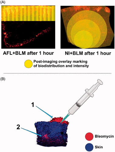 Figure 5. Biodistributionresults interpreted as an overlay on MALDI imaging. A: Biodistribution patterns visualized as post-imaging overlay markings on matrix-assisted laser desorption/ionization images (the original data are shown in Figure 2). AFL + BLM results in a belt-shaped delivery zone, with laser-channel coagulation zones showing the highest concentrations of BLM. NI-BLM shows that the peak BLM concentration is centered on the primary injection point with BLM radiating outwards. B: Example showing that the strongest BLM signal 4 h after NI corresponds to the initial injection site, with almost no residual BLM in the surrounding tissue; 1: BLM remaining on the surface of the skin; 2: Initial point of deposition. The skin-tissue biomarker is shown in blue and BLM is shown in red. MALDI: Matrix-assisted laser desorption/ionization; AFL: Ablative fractional laser; BLM: Bleomycin; NI: Needle injection.