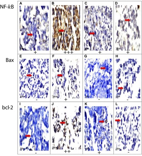 Figure 5 Effect of TAM, SIM, and their combinations on the expression levels of NF-κB, Bax, and bcl-2 in MCF-7 cell lines. Immunohistochemical staining of NF-κB of control non-treated group (A), TAM treated group (B), SIM treated group (C), and combination treated group(D). Immunohistochemical staining of Bax for control group (E), TAM treated group (F), SIM treated group (G), and combination treated group (H). Immunohistochemical staining of bcl-2 for control group (I), TAM treated group (J), SIM treated group (K), and combination group (L) (x160).