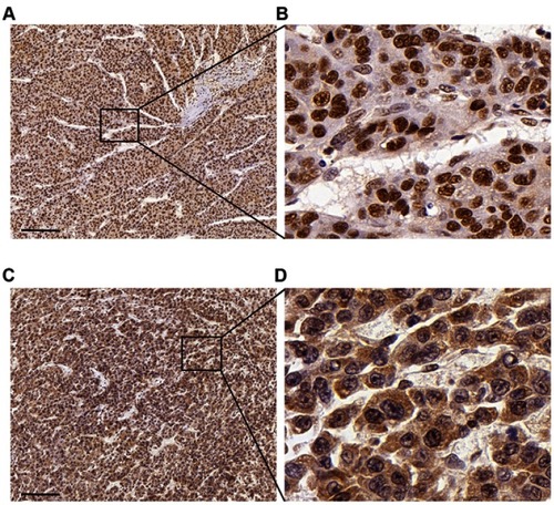 Figure 3 Immunohistochemical staining of METTL3 (A, B) and YTHDF1 (C, D) in HCC tissues Scale bars: 200 μm.