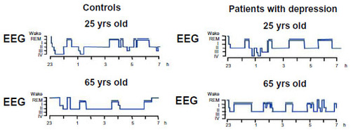 Figure 1 Hypnogram in young and old healthy volunteers, and patients with depression.