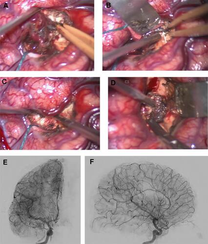 Figure 5 (A–D) Intra-operative views during surgery showing the dark embolized feeding artery which was detached (arrow). Note that the nidus was resected in piecemeal fashion. (E and F) Post-operative cerebral angiography showing total resection of the AVM.