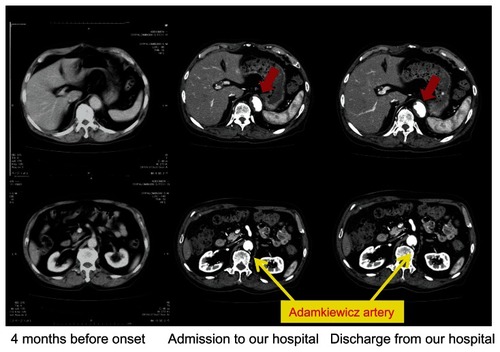 Figure 1 These images show abdominal computed tomography scans obtained at three different timings. Both upper and lower computed tomography images are of the same lesion in the descending aorta. Despite the high flow in his arteries, his intra-aortic thrombi rapidly expanded. After 2 weeks of anticoagulation, his thrombi reduced in size.