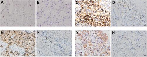 Figure 1 Representative ISH and IHC images. (A) HPV ISH–positive HNSCC; (B) HPV ISH–negative HNSCC; (C) p16-positive HNSCC; (D) p16-negative HNSCC; (E) p53-positive HNSCC; (F) p53-negative HNSCC; (G) TLR9-positive HNSCC; and (H) TLR9-negative HNSCC. Scale bar: 20 μm; magnification ×400.