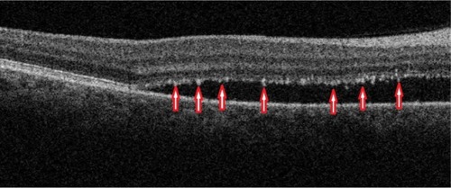 Figure 8 B-scan SD-OCT image demonstrating edema residues confined to the level of photoreceptor outer segment layer in CSC.