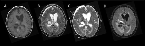 Figure 3 Brain MRI revealed partial blood accumulation in the right thalamus associated with mild hydrocephalus. (A) T1-weighted image; (B) T2-weighted image; (C) diffusion-weighted image (DWI); (D) flair image.