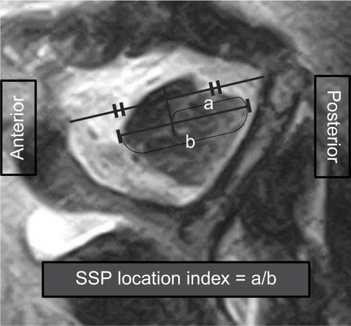 Figure 1 Measurement of SSP location index.