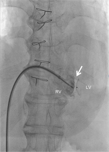 Figure 6 Percutaneous transcatheter AMPLATZER™ Muscular VSD Occluder device inserted across ventricular septal defect.