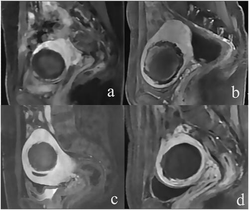 Figure 1. Enhanced MR images of uterine fibroids with different ablation rates (NPVR) after HIFU treatment (a) For anterior uterine fibroids, no perfusion volume (NPV) was 48.1 cm3, and NPVR was 62.3%. (b) Anterior uterine fibroids, with NPV of 69.1 cm3 and NPVR of 72.0%; (c) Anterior uterine fibroids, with NPV of 90.2 cm3 and NPVR of 88.9%; (d) Anterior uterine fibroids, NPV 69.2 cm3, NPVR 99.6%.