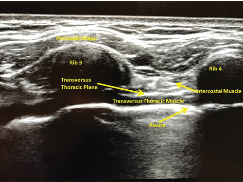 Figure 1. Ultrasound view of the transverse thoracic muscle plane.