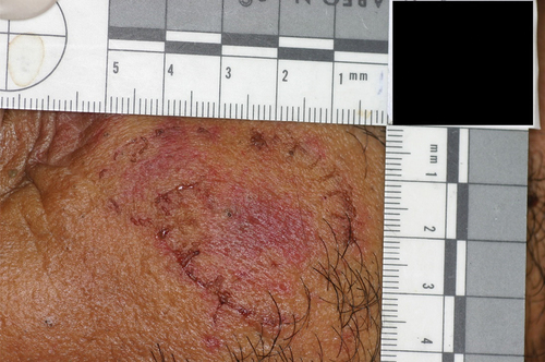 Figure 1. Bite mark wound on human epidermal tissue. Source: Anthony R. Cardoza, DDS, D-ABFO.