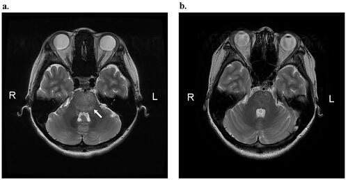 Figure 1. (a) T2-weighted brain MRI before treatment. The arrow indicates brainstem edema. (b) T2-weighted brain MRI after treatment. Brainstem edema was reduced.